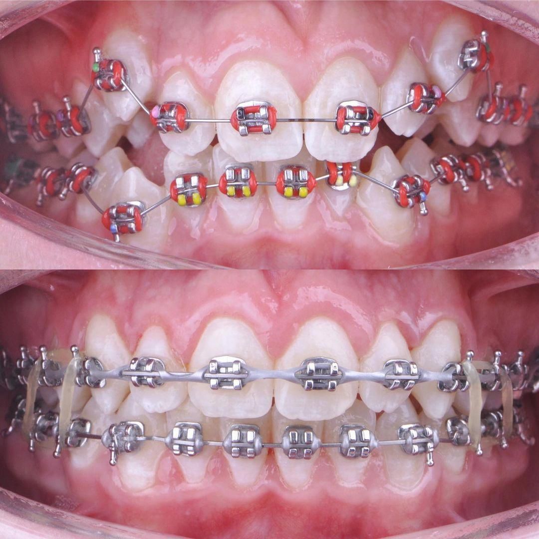 20 tuổi niềng răng bao nhiêu tiền